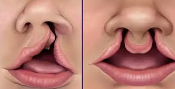 Cleft lip and palate (CLP) is the commonest birth anomaly affecting the face of newborn babies. Cleft lip and palate (CLP) is the commonest birth anomaly affecting the face of newborn babies.