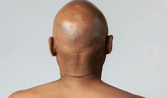 Baldness breakthrough: Serum regrows hair in 20 days