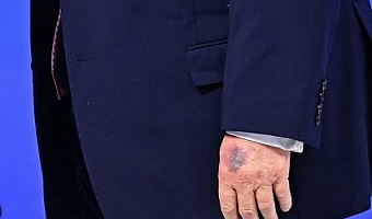 US President Donald Trump has sparked public concern after a noticeable bruise was seen on his left hand