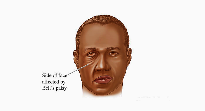 Facial muscles affected by Bell's palsy Facial muscles affected by Bell's palsy