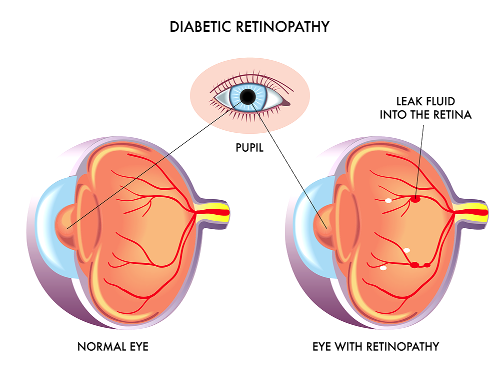 diabetic eye diabetic eye