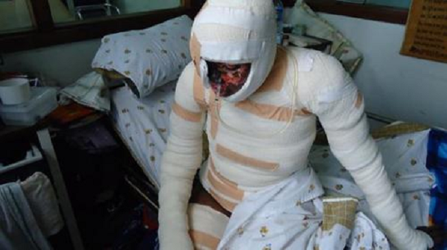 Man douses girlfriend in acid 