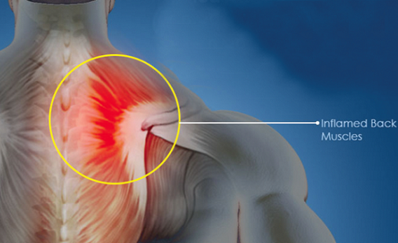 Spondylosis may affect any part of your spine-neck, upper and lower back Spondylosis may affect any part of your spine-neck, upper and lower back