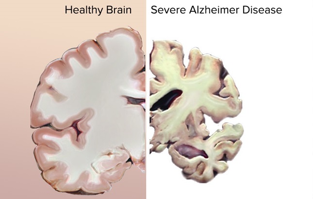 Looking at factors increasing risk of dementia