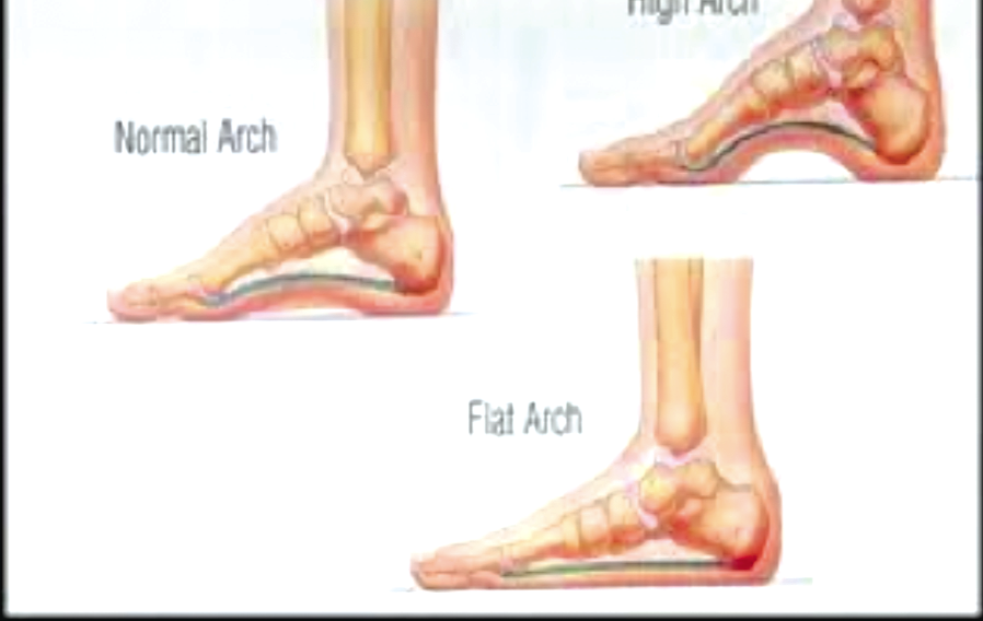 • Due to the fallen arches there are alterations in the placement of the foot on the ground. • Due to the fallen arches there are alterations in the placement of the foot on the ground.