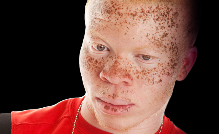 Albinism: My complexion or my person? Albinism: My complexion or my person?