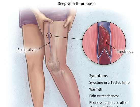 Deep vein thrombosis (DVT) is a blood clot (thrombus) inside a deep vein in the body Deep vein thrombosis (DVT) is a blood clot (thrombus) inside a deep vein in the body