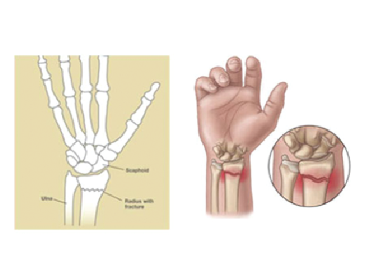 Retoration of flexibility in your wrist is essential Retoration of flexibility in your wrist is essential