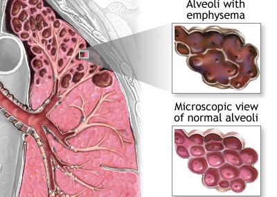 How do you get disease of the lung?