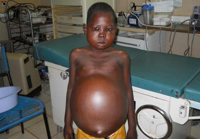 Nephrotic syndrome can also result from a systemic diseases - secondary causes. examples of such diseases include diabetes mellitus, lupus erythematosus, hepatitis B, HIV, malaria and sickle cell disease. Nephrotic syndrome can also result from a systemic diseases - secondary causes. examples of such diseases include diabetes mellitus, lupus erythematosus, hepatitis B, HIV, malaria and sickle cell disease.