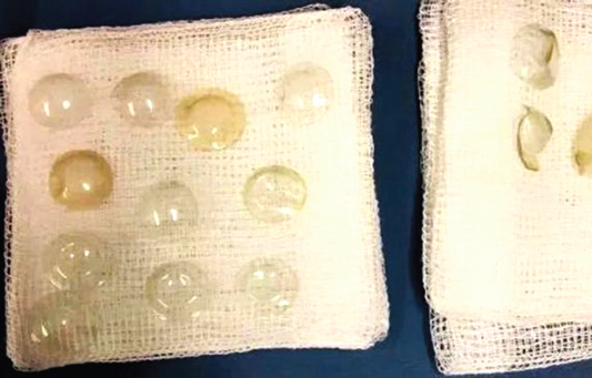 The doctors were shocked to find such number of contact lenses on one eye The doctors were shocked to find such number of contact lenses on one eye