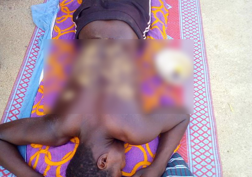 One of the victims with severe back wounds resulting from lashes One of the victims with severe back wounds resulting from lashes