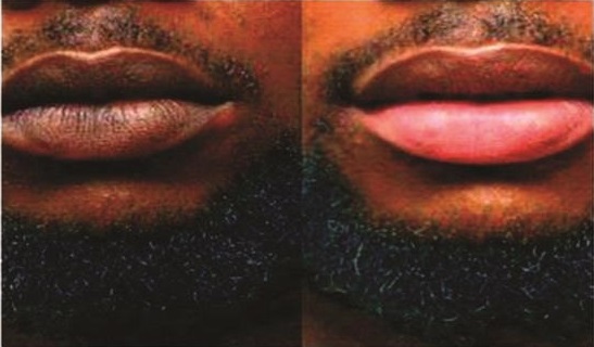 FDA warns against use of harmful 'pink-lips' creams