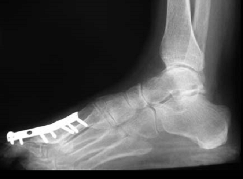 Signs of fused foot bones