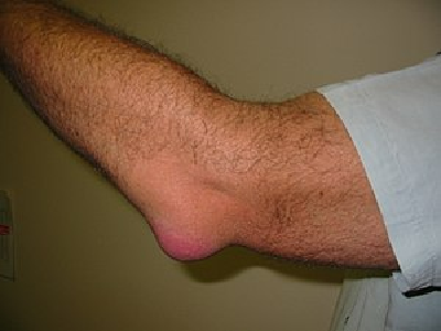 How elbow sprain occurs How elbow sprain occurs