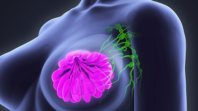 Surviving breast cancer: A survivor’s experience Surviving breast cancer: A survivor’s experience