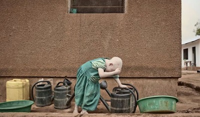 Albinism affects around one in every 1,400 Tanzanians, far higher than average Tanzania arrests 65 'witchdoctors' over killings