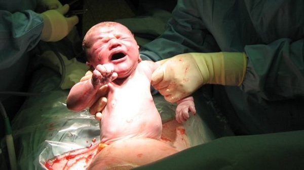 Caesarean delivery Caesarean delivery