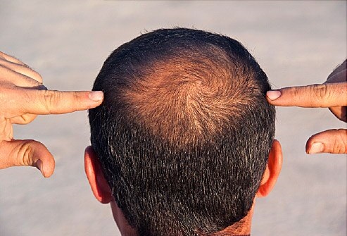 Hair loss treatment for men