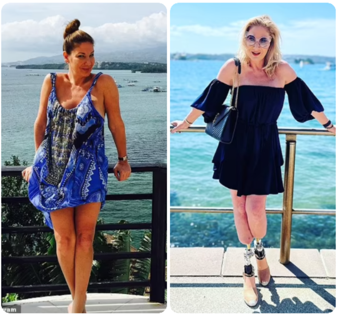 Australian socialite reveals how she had both feet amputated after contracting malaria