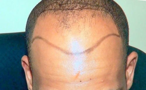 Most men attribute their receding hairline to genetics Most men attribute their receding hairline to genetics
