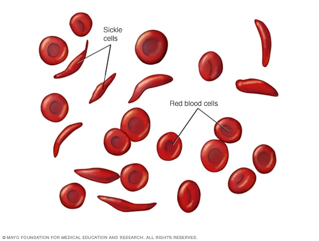 Sickle-shaped red blood cells are sticky and prone to forming clumps and blocking blood vessels anywhere in the body. Different types of crises in sickle cell