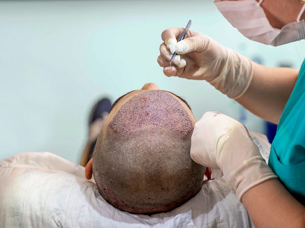 Baldness is a common issue affecting most men Tattoos, surgeries to the rescue of bald men