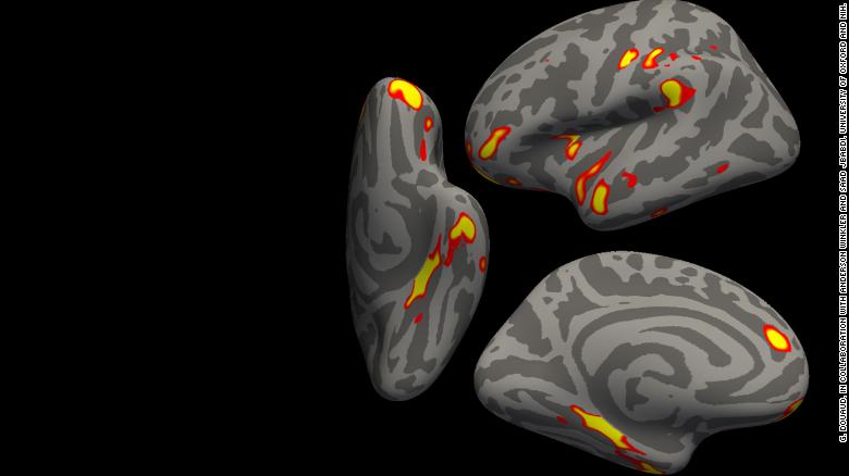 Study links even mild Covid-19 to changes in the brain