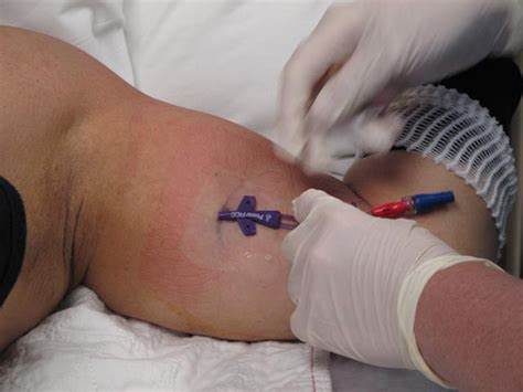 Treatment for leukemia