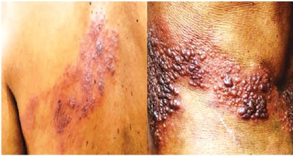 A patient suffering from Ananse