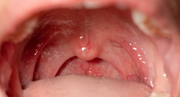 Epstein pearls are caused by a build-up of keratin in the soft and hard palates. My baby has whitish things on his hard palate