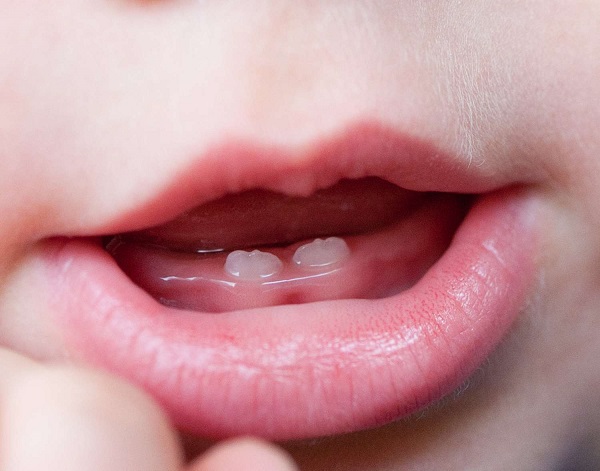 Newborns with a tooth or teeth are not an unusual observation in the labour wards What do you know about newborns with teeth?