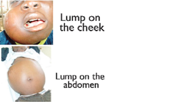 Commemoration of International Childhood Cancer Day - Awareness on childhood cancer crucial