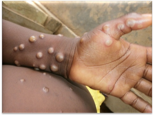 34 new Mpox cases confirmed across 10 regions in Ghana, total case count now 79
