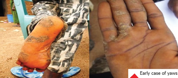 Buruli ulcer, leprosy: Low level awareness increases spread Buruli ulcer, leprosy: Low level awareness increases spread