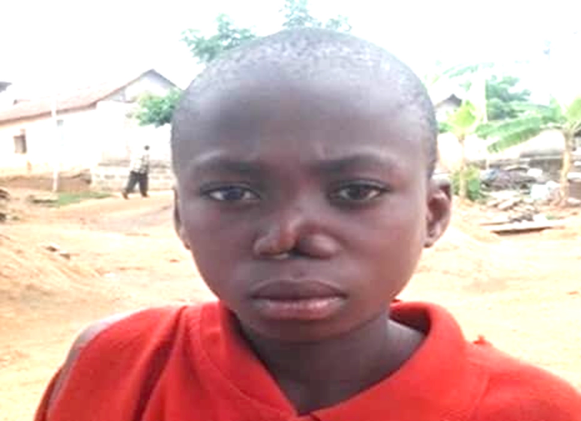 A child with a collapsed nose as a result of yaws.  Buruli ulcer, yaws infections high among children