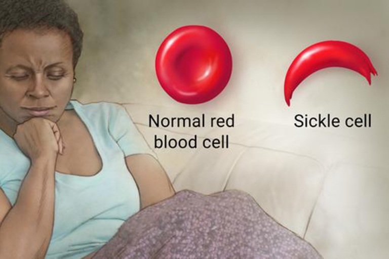 Crises in Sickle Cell Disease