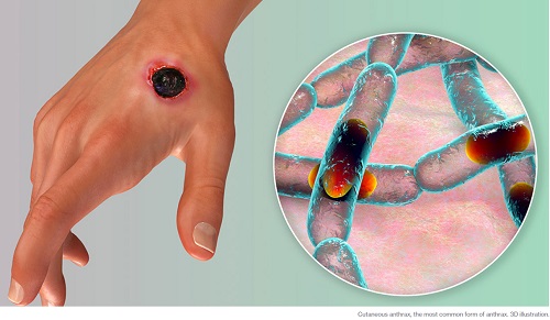 Five things you need to know about anthrax