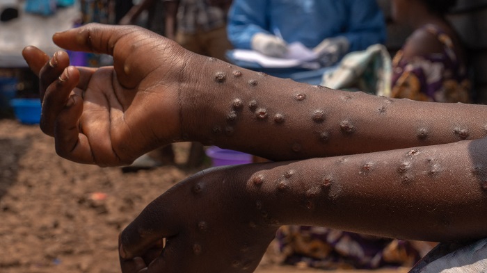 Six new Mpox cases confirmed in Ghana, total rises to 91