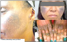 Identity crisis of skin bleaching
