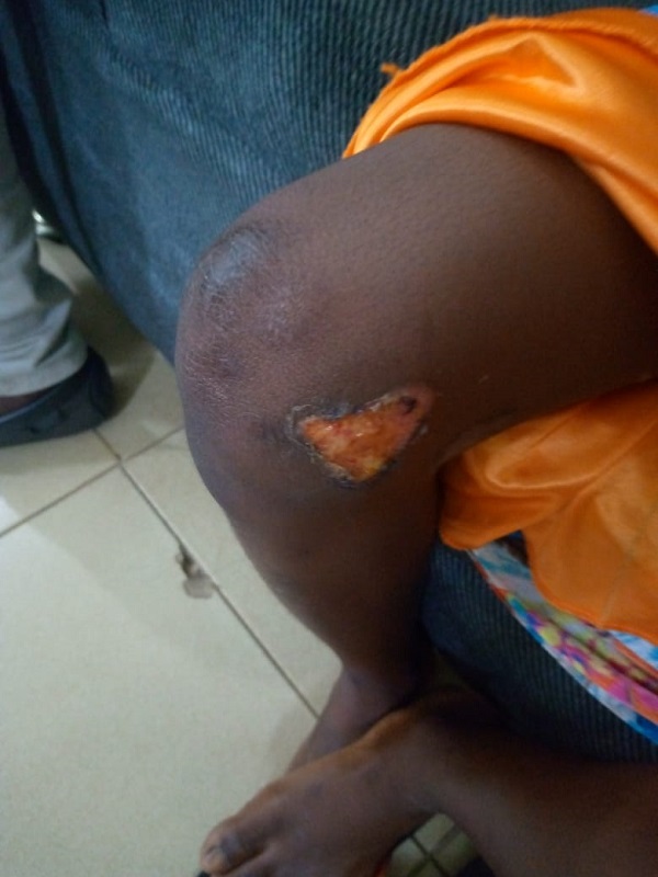 The burns on the girl Woman arrested for repeatedly burning niece with pressing iron