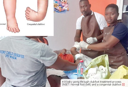 Commemoration of World Clubfoot Day: Parents advised to report early cases of clubfoot condition