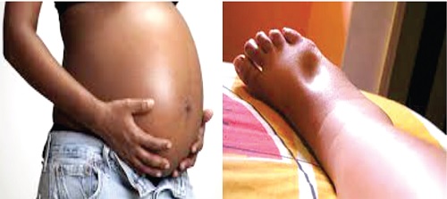 A pregnant woman, A sign of oedema in pregnancy A pregnant woman, A sign of oedema in pregnancy