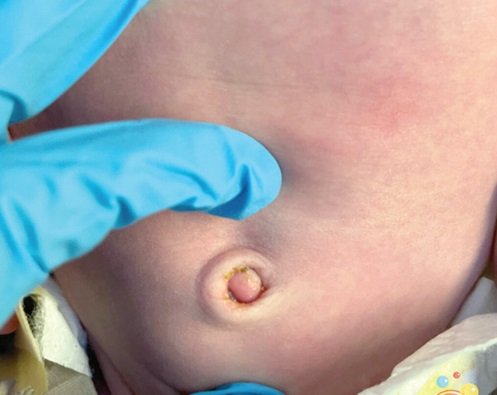 An umbilical granuloma is an overgrowth of tissue during the healing process of the belly button An umbilical granuloma is an overgrowth of tissue during the healing process of the belly button
