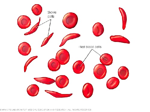 Is it possible to have a child with sickle cell?