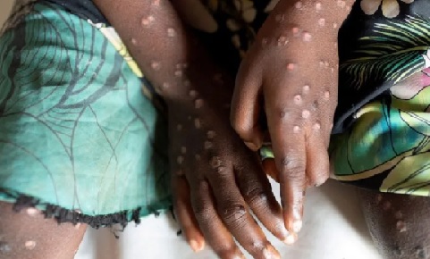 Ghana record 21 new Mpox cases, total now at 218 Ghana record 21 new Mpox cases, total now at 218
