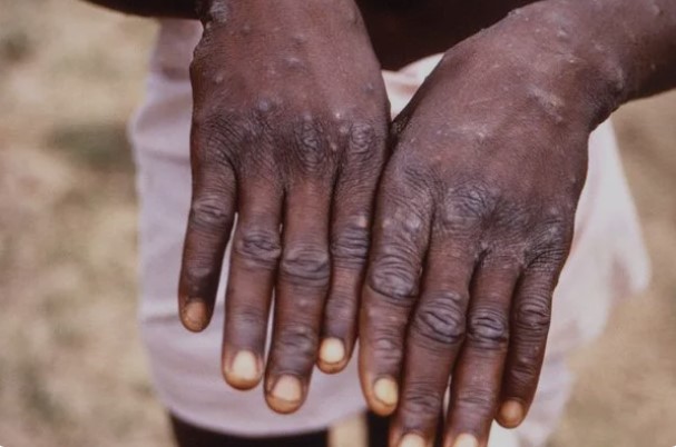 Ghana confirms 16 new Mpox cases as total rises to 234 Ghana confirms 16 new Mpox cases as total rises to 234