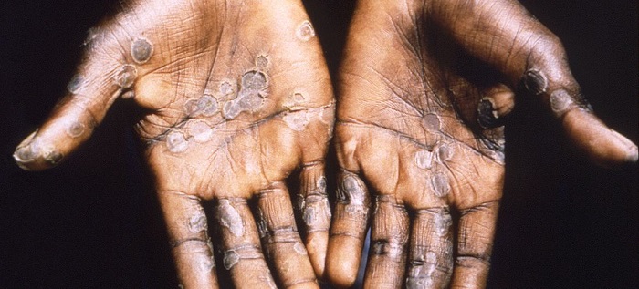 First Mpox death recorded in Ghana; 23 new cases confirmed