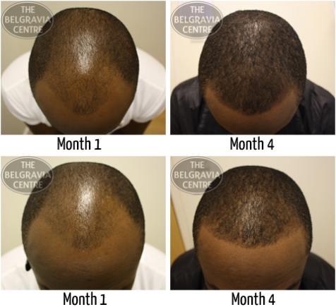 LIBRARY PHOTO: An example of male pattern hair loss client's success story LIBRARY PHOTO: An example of male pattern hair loss client's success story
