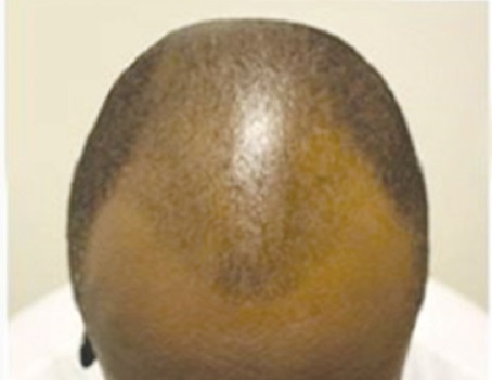 Receeding hairline Receeding hairline